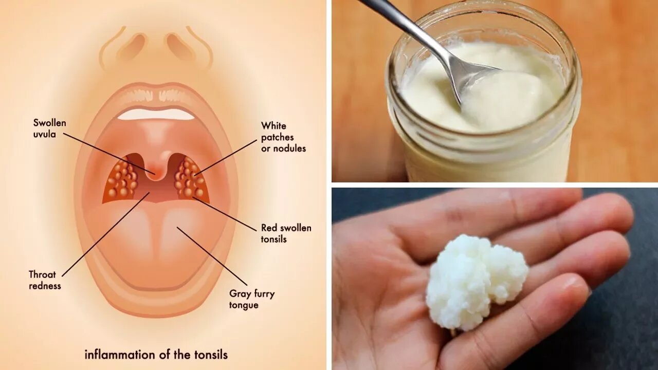 3 Powerful Home Remedies for Tonsil Stones That Work Fast! (Tonsilloliths)