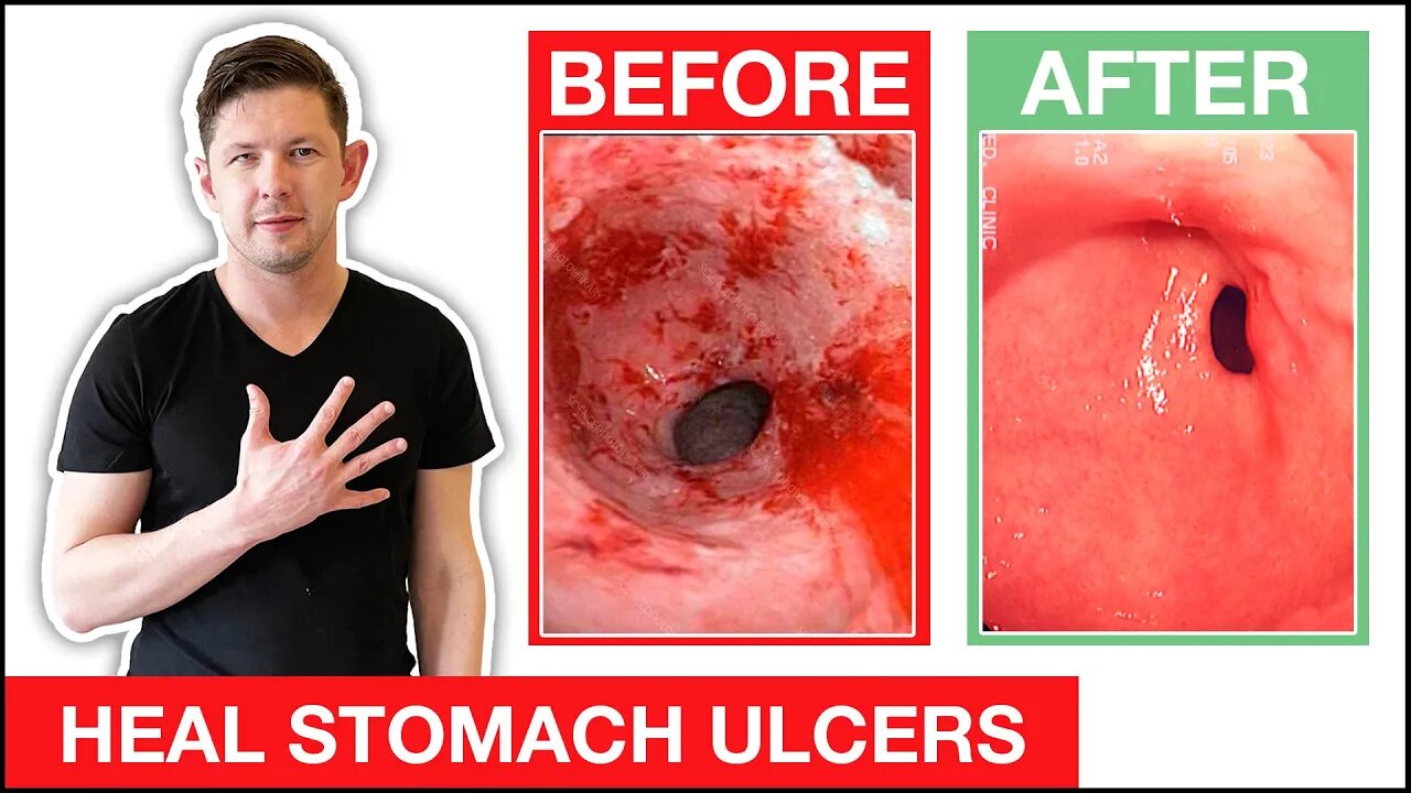 5 Dangerous Holistic Medicine Myths For Heartburn, Acid Reflux & GERD
