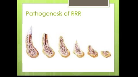 Prosthodontics L2 (Residual Ridge Reduction)