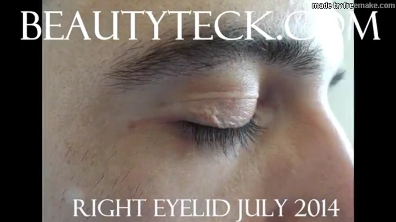 Andreas Upper Eyelid Tightening Normal Speed