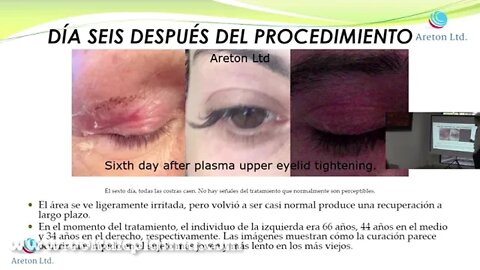 CASO ESTUDIO DEL PROCESO CURATIVO DE PÁRPADO SUPERIOR CON PLASMA