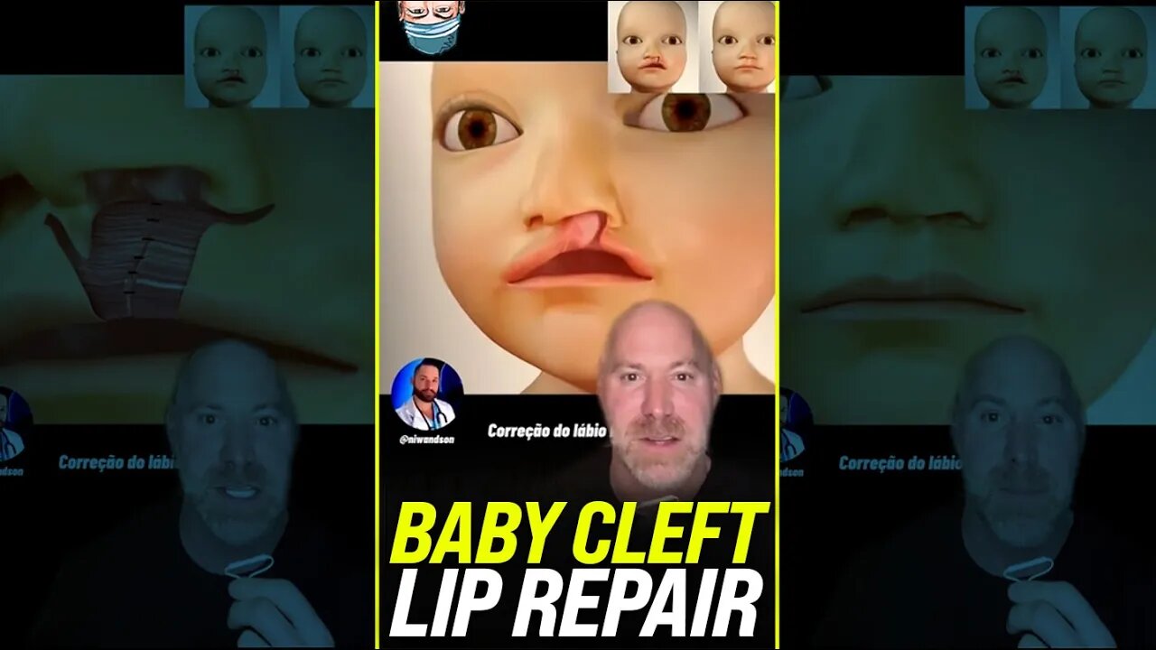 Baby Cleft Lip Repair 👶🏻 #shorts