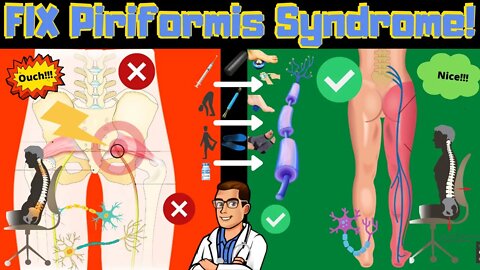 Piriformis Syndrome Won't Go Away? [Stretches I Exercises I Treatment]