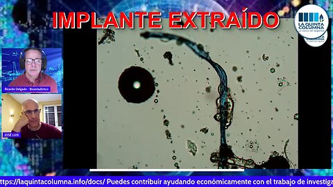 IMPLANTE EXTRAÍDO