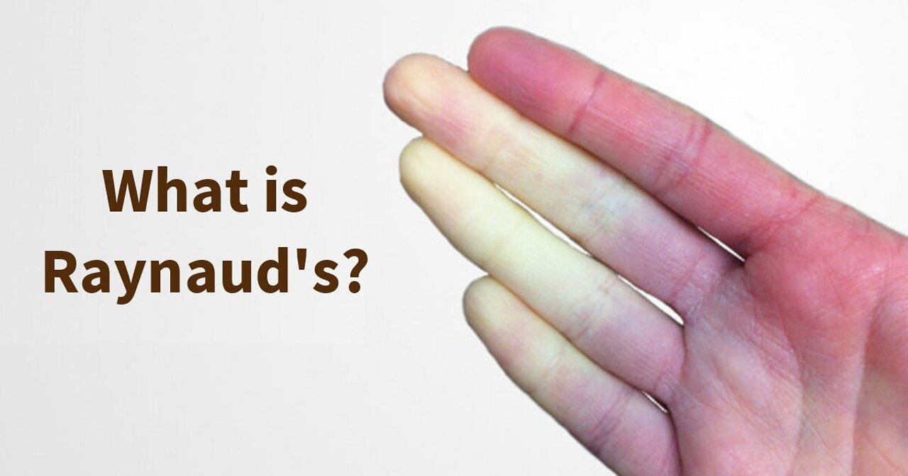 Raynaud's Disease (Is there an Rh negative blood connection?)