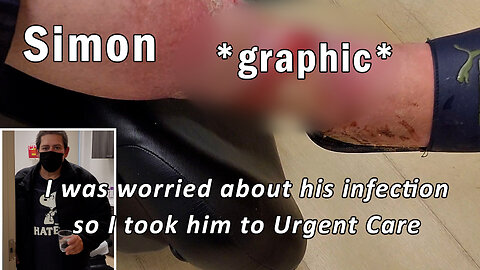 Simon - Infection in Legs that needed treatment immediately