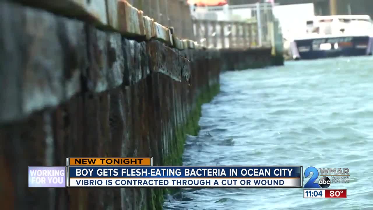 Boy gets flesh-eating bacteria in Ocean City