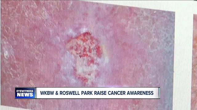 Skin Cancer Roswell