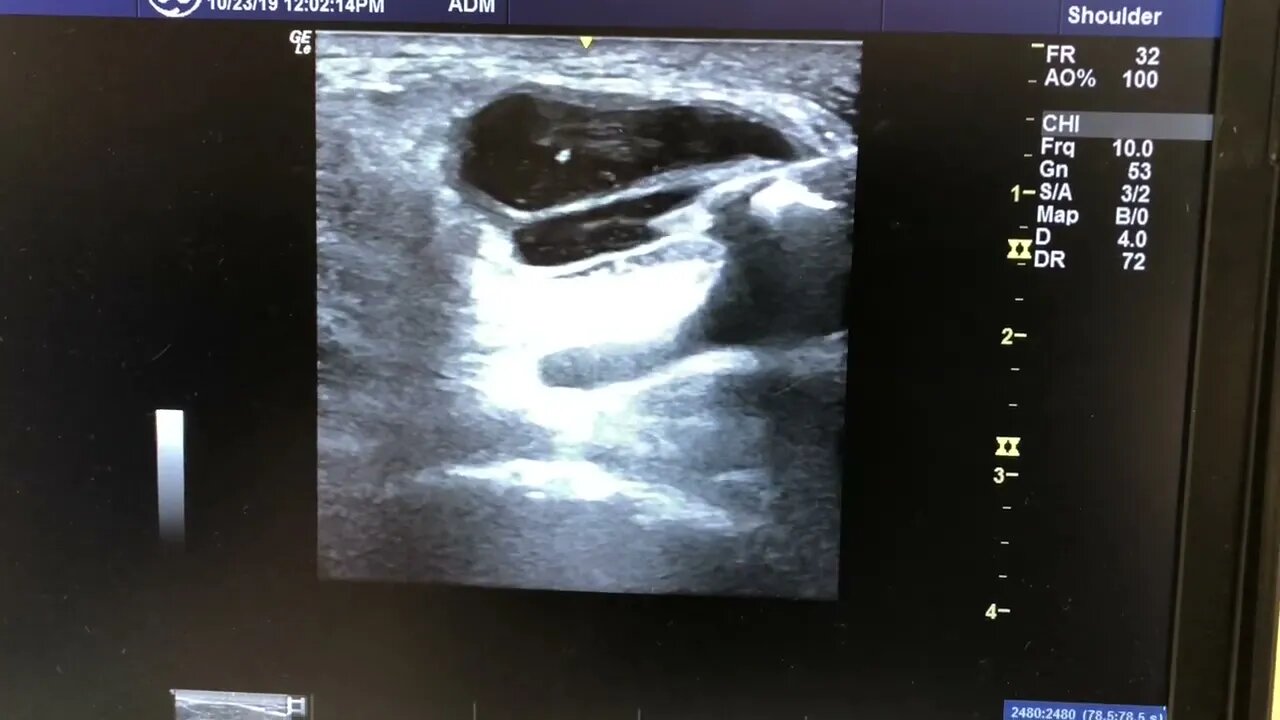 I have to have this procedure Baker's Cyst Aspiration