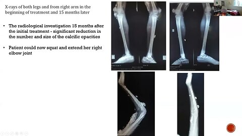 HOMEOPATHY IN HETEROTROPIC OSSIFICATION