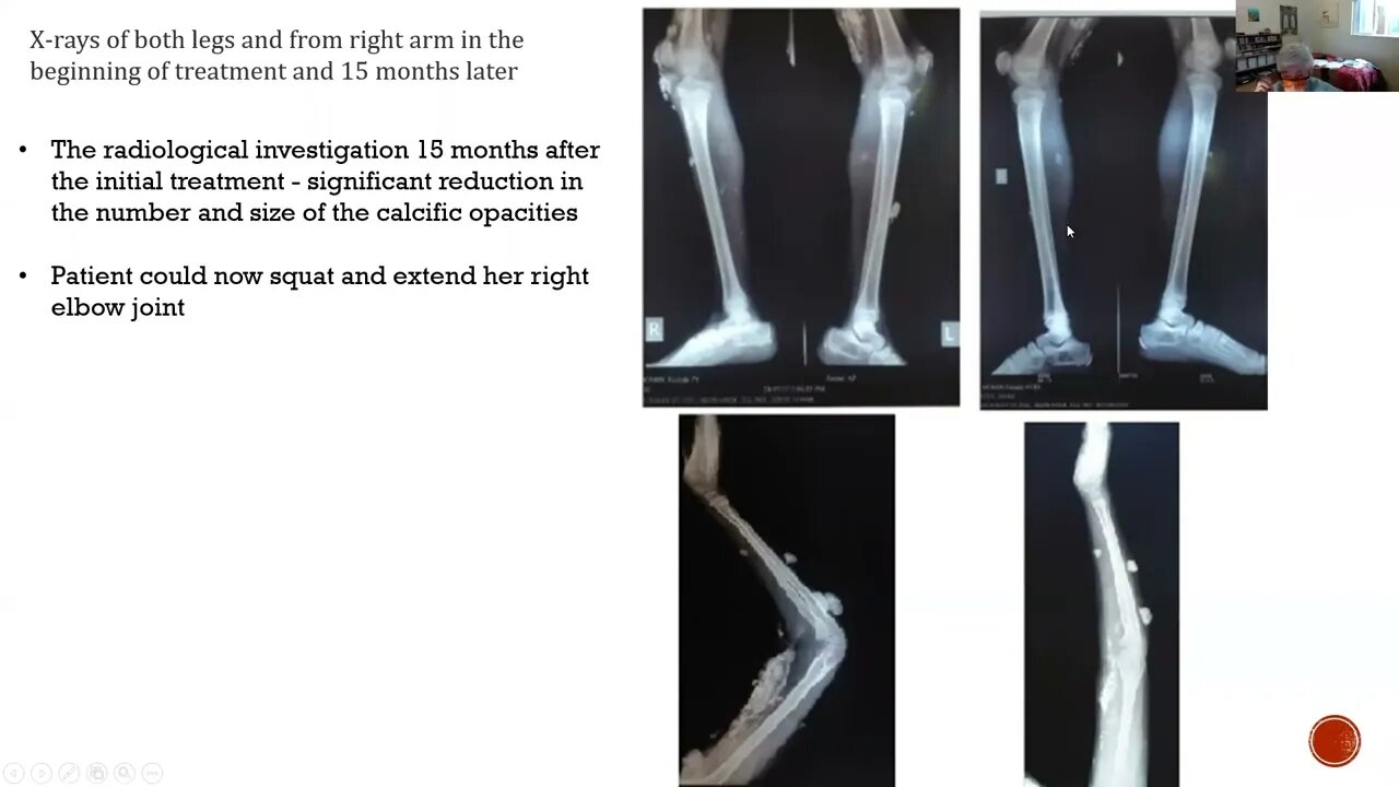 HOMEOPATHY IN HETEROTROPIC OSSIFICATION