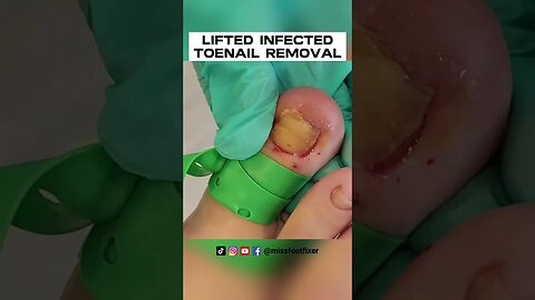 LIFTED DAMAGED/INFECTED TOENAIL REMOVAL 2023 BY FEET DOCTOR MISS FOOT FIXER
