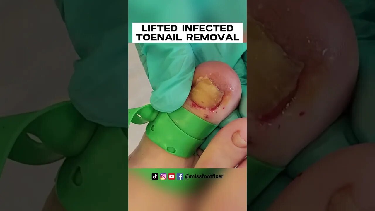 LIFTED DAMAGED/INFECTED TOENAIL REMOVAL 2023 BY FEET DOCTOR MISS FOOT FIXER