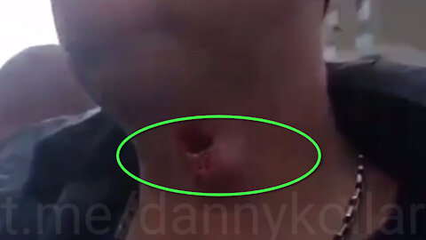 Man shot in the neck with a rubber bullet by police in Slovakia during anti-covid demonstrations