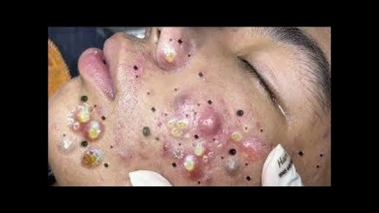 Satisfying blackhead removal, relaxing Pimple Popping 116