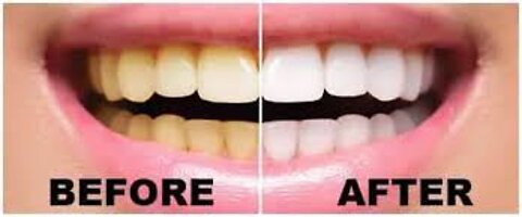 Cleaner Smile Teeth Whitening Kit