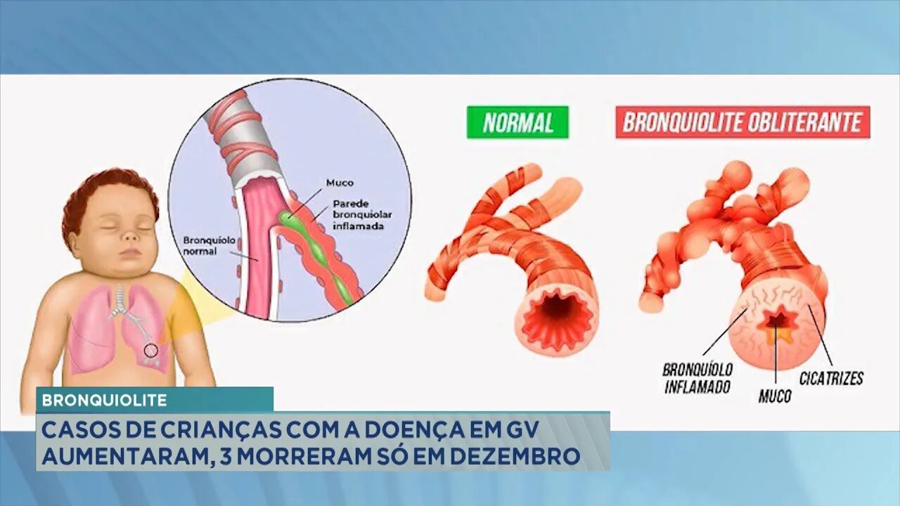 Bronquiolite: Casos de Crianças com a Doença em GV Aumentaram, 3 Morreram Só em Dezembro.