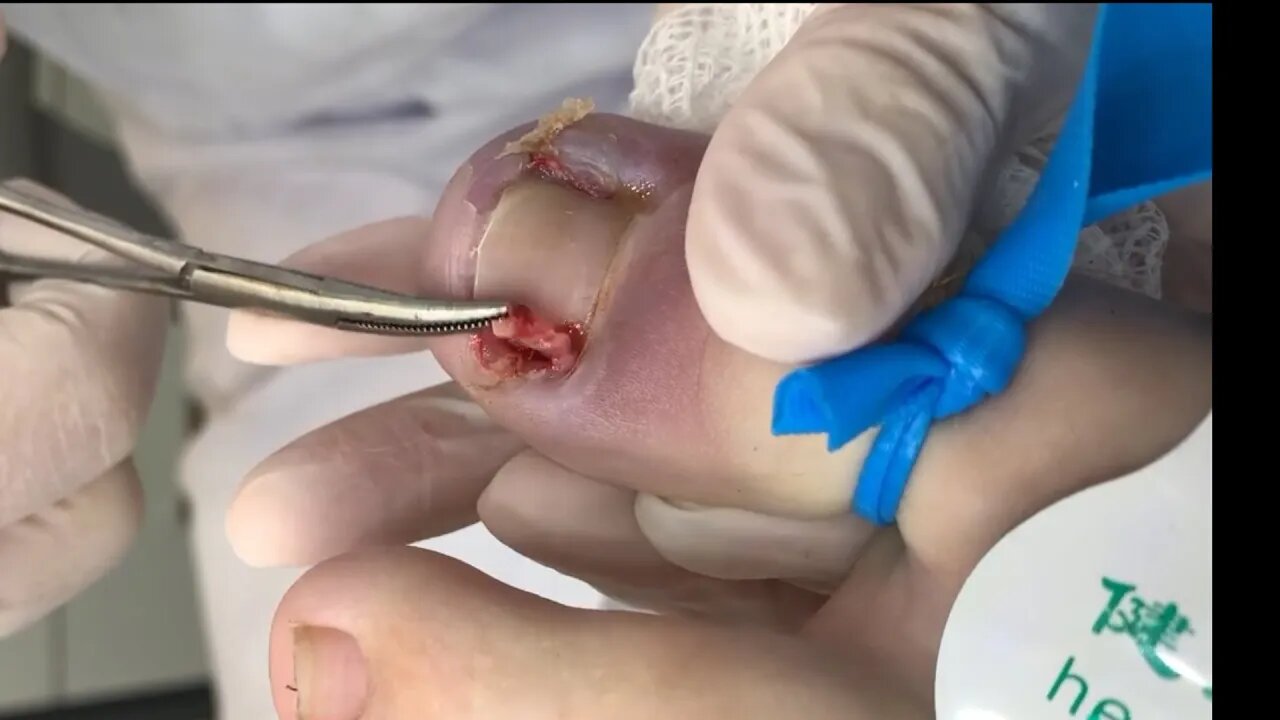 unha encravada ambos os lados | ingrown toenail both sides #podologia #podiatrist #ingrown_toenail