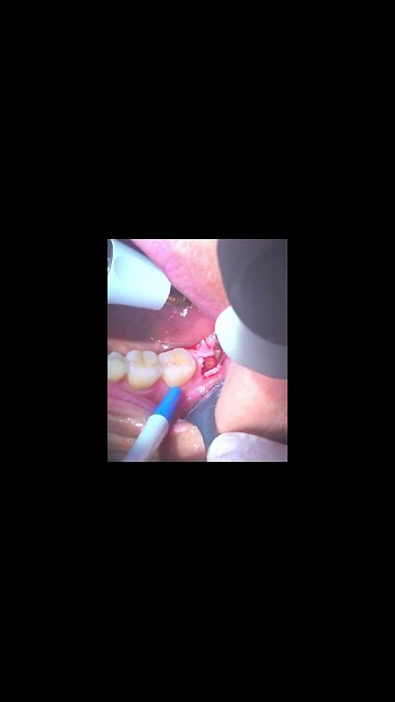 Jawbone surgery showing fat globules & purulent discharge from the jawbone of a patient.