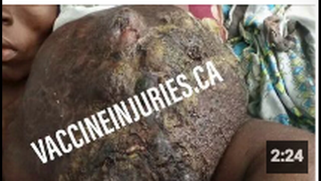 Two Victims Suffer Horrific Covid-19 Vaccine Side Effects - One Of Them Passed Away (2023)