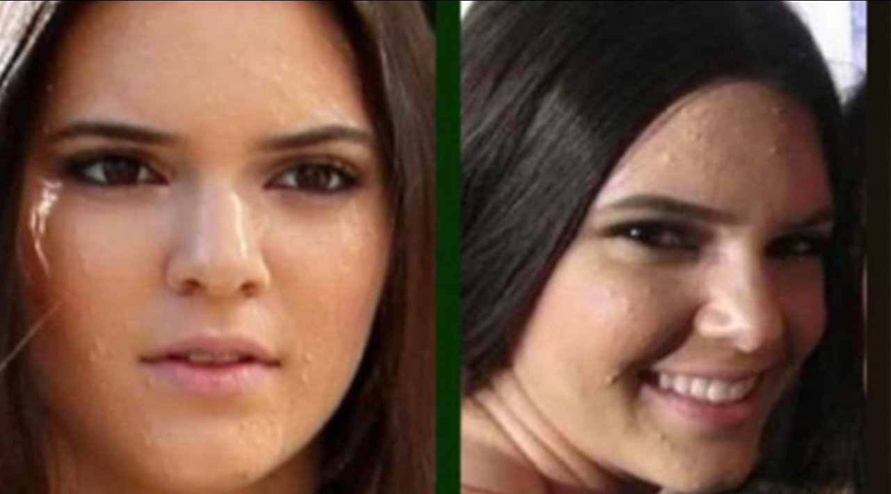 Kendall Jenner Opens Up In Emotional Post About Her Debilitating Struggle With Acne
