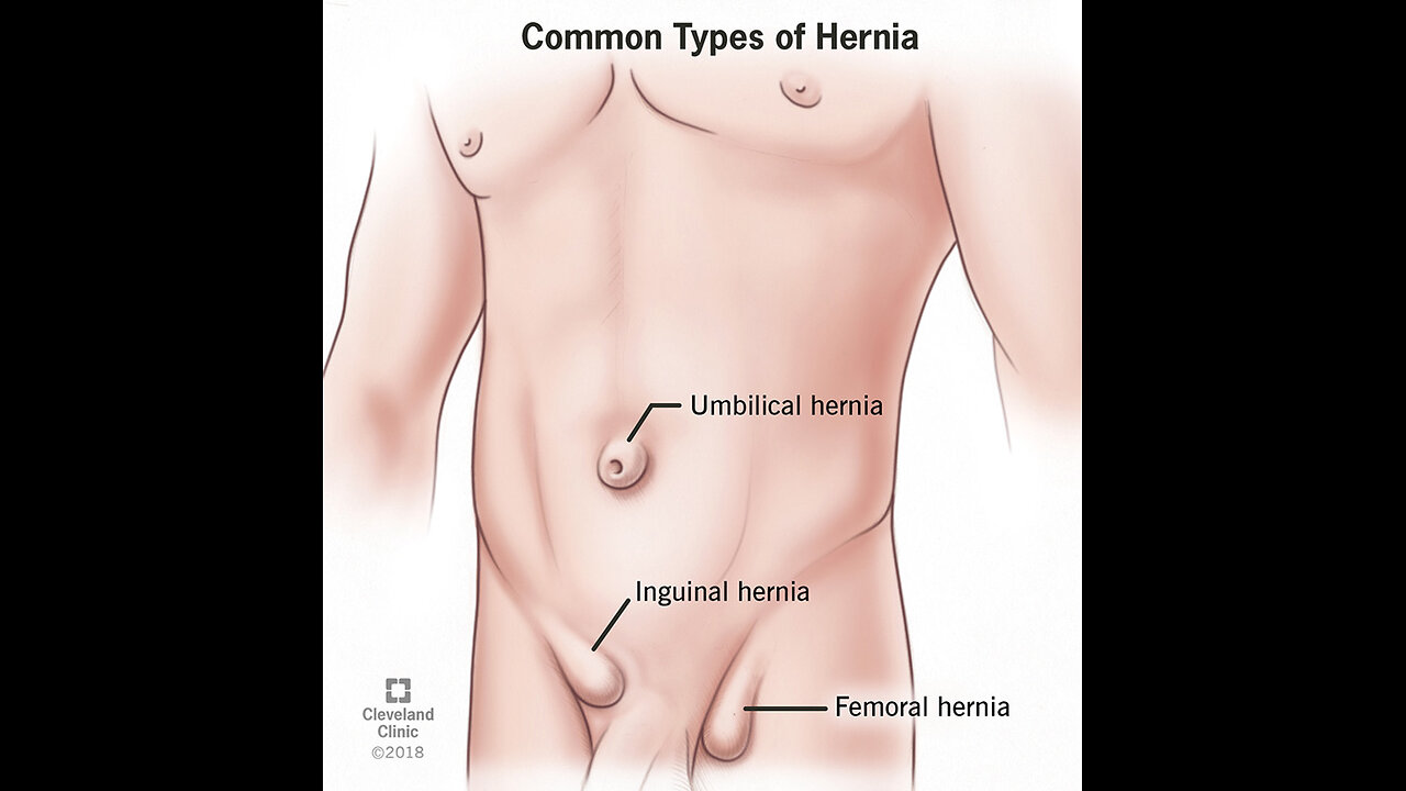 Hernia 3D Animation Video