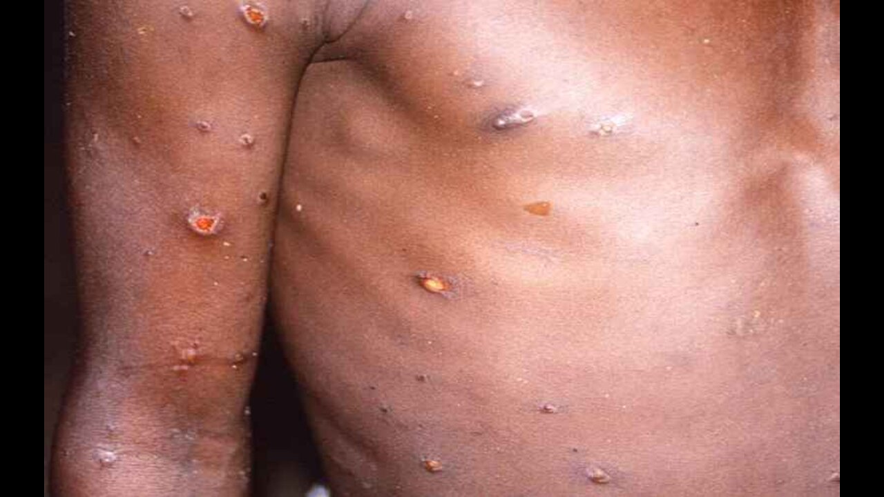 Over 550 Monkeypox Cases Reported as Virus Spreads Undetected