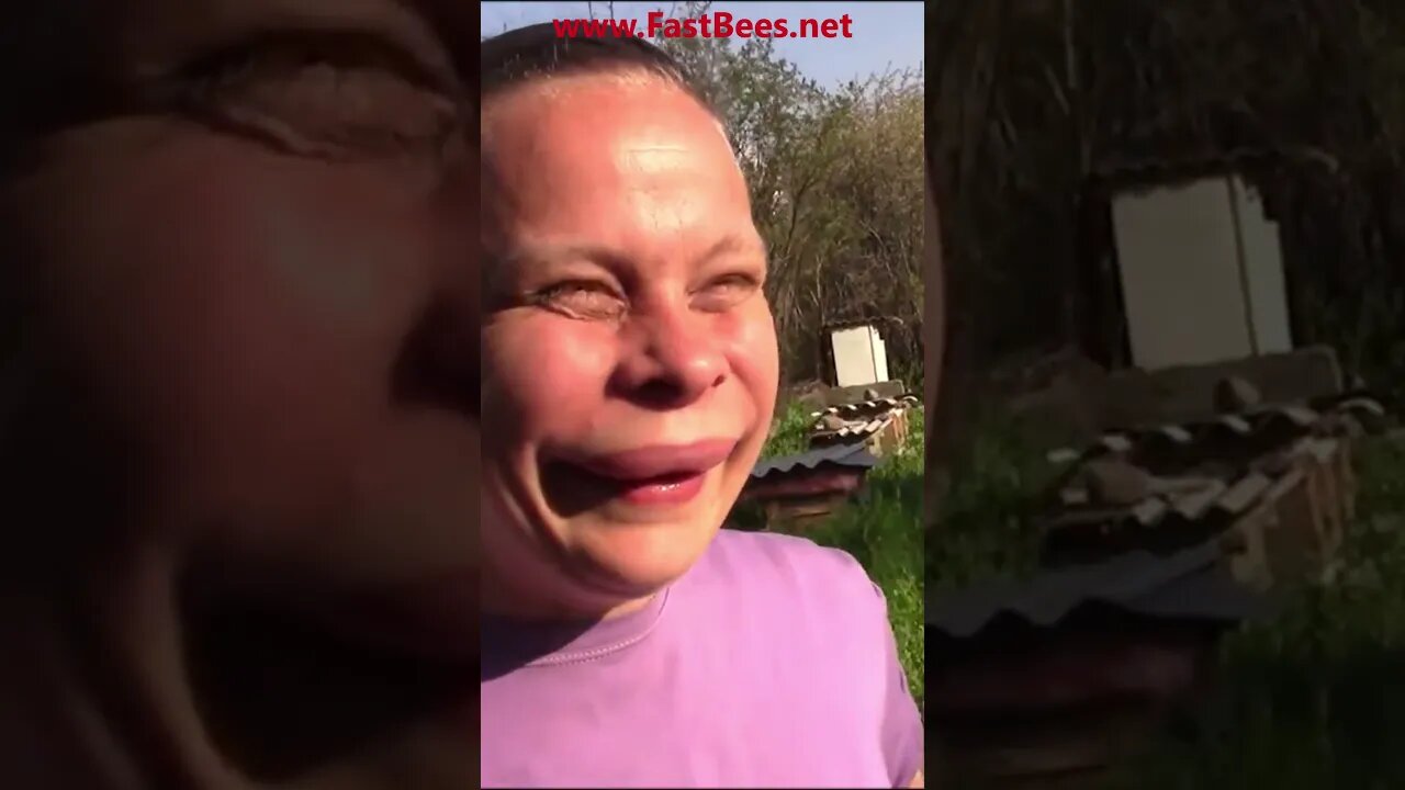 I Look Like a Cartoon After Bee Attack