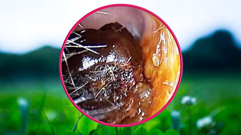Ear Wax Removal With Clam Relaxing Music #47