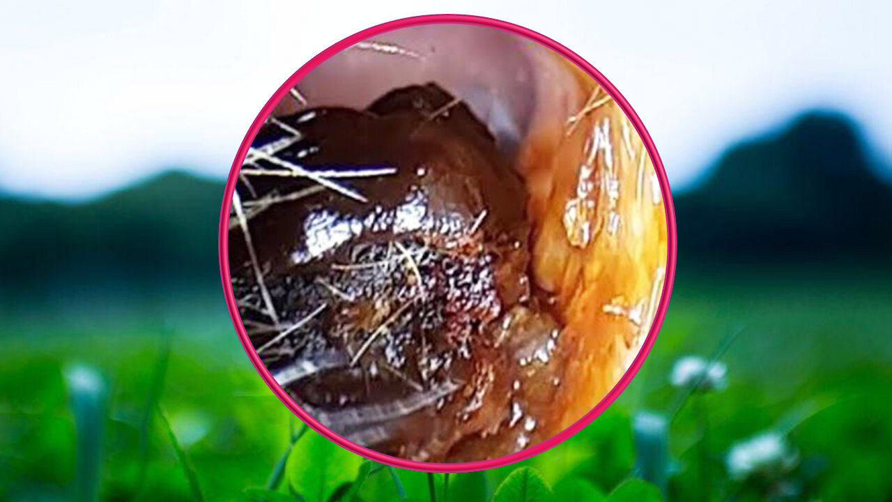 Ear Wax Removal With Clam Relaxing Music #47
