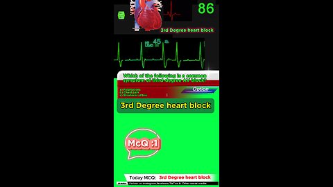 Third Degree Atrioventricular Block: heart, cardiology, atrioventricular block,MCQS