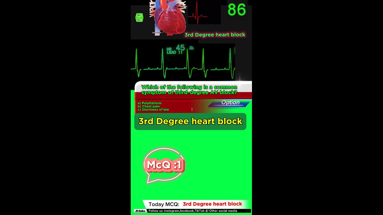Third Degree Atrioventricular Block: heart, cardiology, atrioventricular block,MCQS