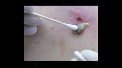 WOW HUGE BLACKHEAD EXTRACTED