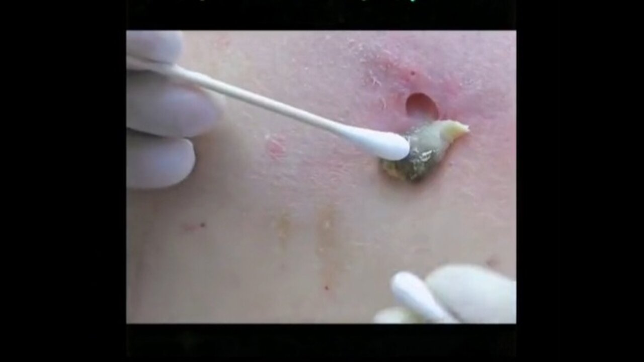 WOW HUGE BLACKHEAD EXTRACTED