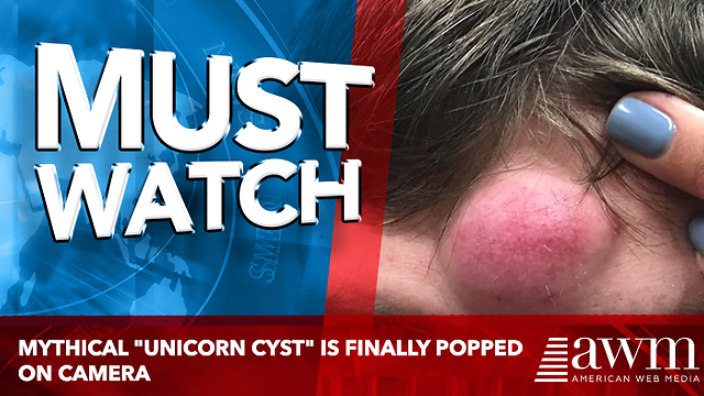 Mythical "Unicorn Cyst" Is Finally Popped On Camera