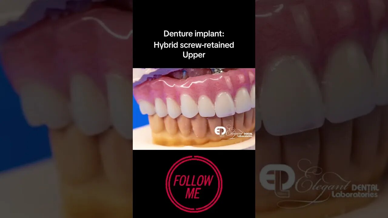 Denture Implant Showcase