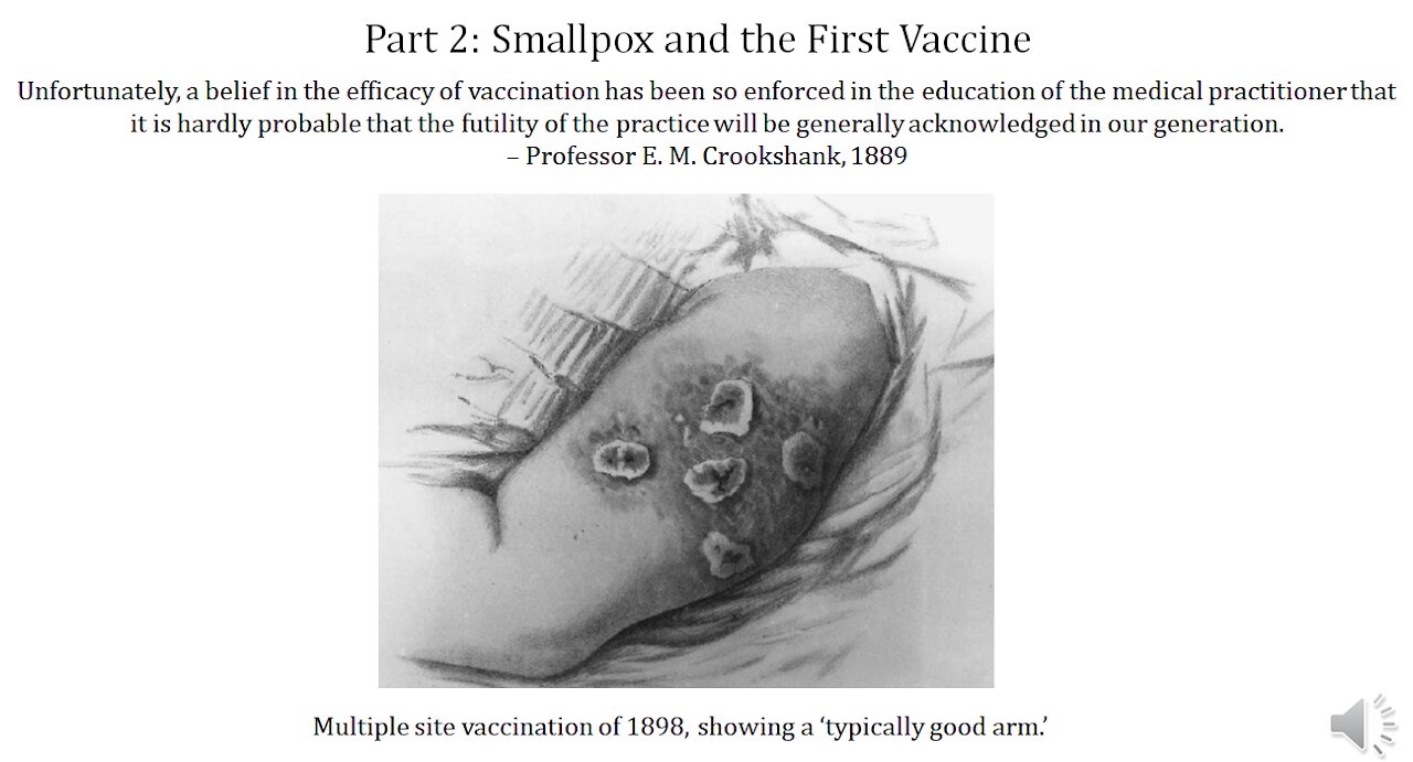 Infectious Disease History and Today - 2. Smallpox