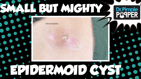 Small but Mighty Annoying Epidermoid Cyst