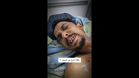 رامي افرج عنه الاحتلال أكد الطب الفلسطيني انه فقد البصر ونزيف دماغي ورضوض واستئصال لأعضاء داخلية.