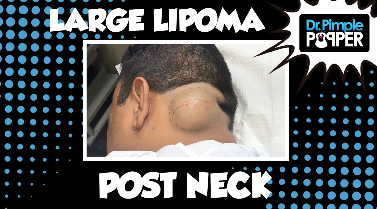 El Diablo Nino Lipoma