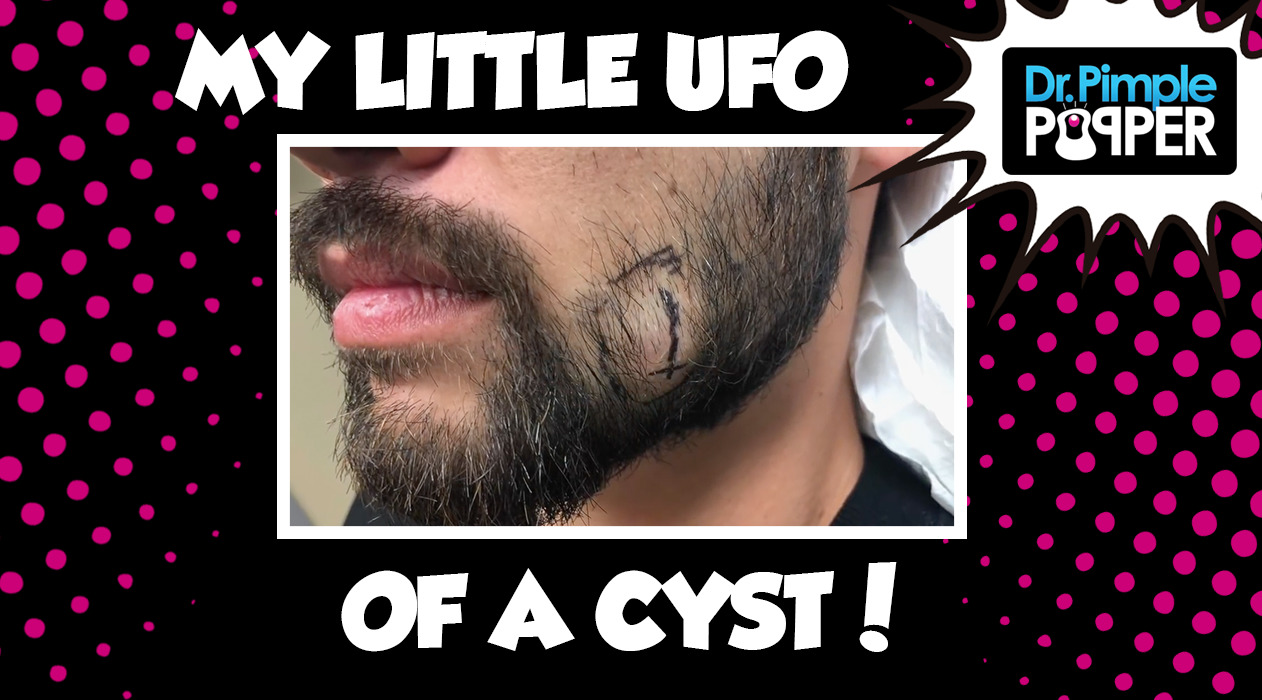 My Little UFO Cyst