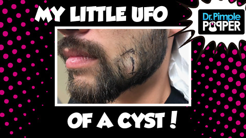 My Little UFO Cyst