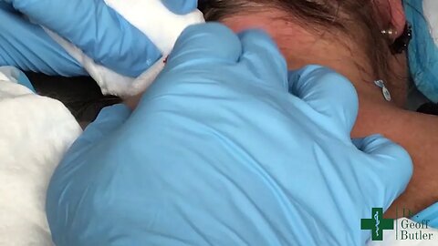 Drainage of an infected epidermal cyst at the base of the neck