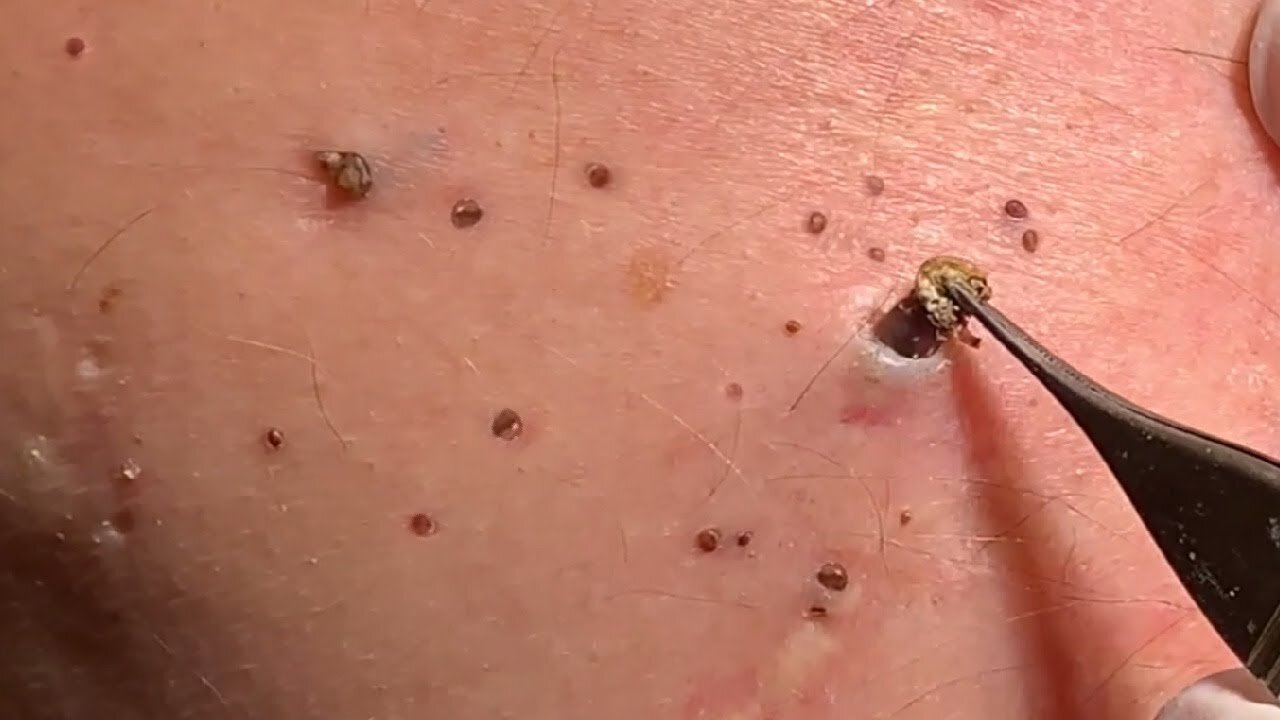 Best relax video acne