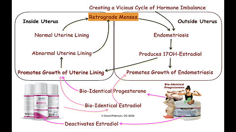 Progesterone Prescriptions: Are They Worsening Your Endometriosis Symptoms?