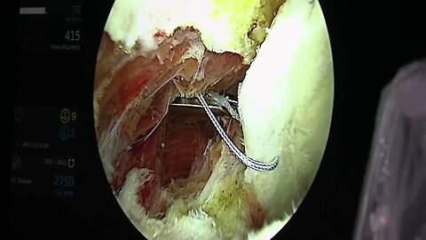 Labral repair - Scott A Barbour, M.D.