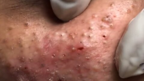 How to remove blackheads and whiteheads at home | How to remove acne #1