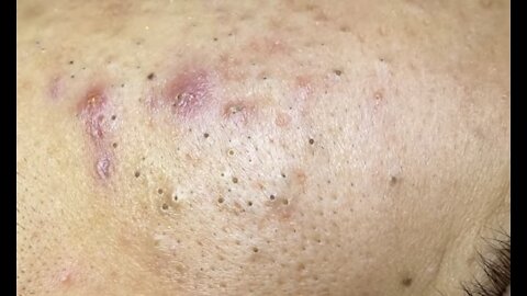 #1 Blackhead & Acne Treatment Ultimate relaxation 1st episode