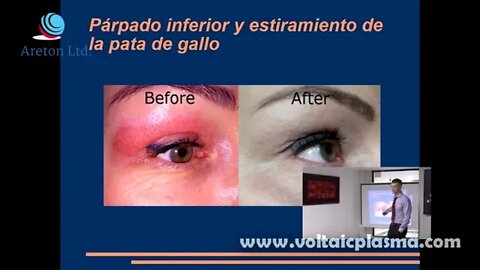 APLIACION DE PLASMA ACTO II