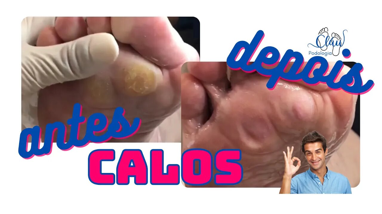 CALOS e calosidades, remoção com profissional #calosidade #pes #dor